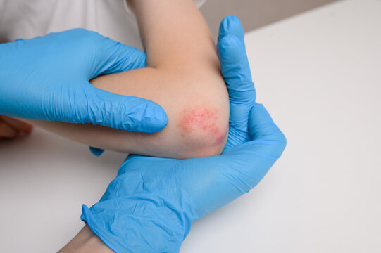  Pediatric dermatologist examines red, inflamed areas on child elbow, close-up. Child suffers from attacks of allergies and dermatitis. Concept of dermatological skin diseases.
