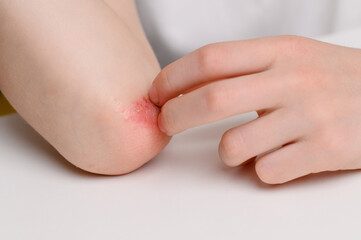 Child scratches reddened, inflamed areas with scabs on his elbow, close-up. Child suffers from attacks of allergies and dermatitis. Dermatological skin diseases concept.
