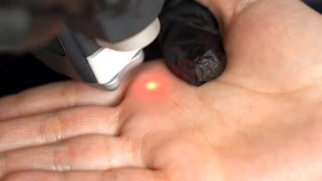Doctor cosmetologist in gloves removes the wart with laser technology from the patient palm in modern beaty clinic