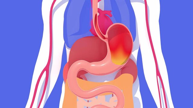 Anatomical 3D animation of the digestive system with burning and heartburn. About a human silhouette and internal organs in flat colors. Seen from the front on a blue background.