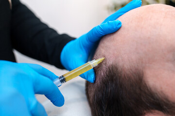 Close-up of a PRP injection into the scalp to treat hair loss.