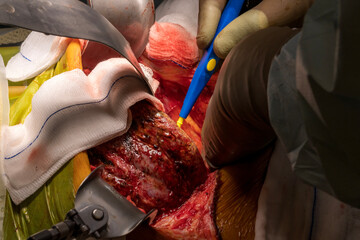 A group of surgeons remove a surgical operation to cut out a cancerous tumor or liver, kidney,...