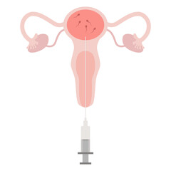 IUI treatment, Intrauterine insemination, Donor sperm service. The planing pregnant Illustration with egg cell, sperm cell good for poster medical clinic. Intrauterine insemination IUI - 783410054