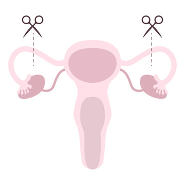 Tubectomy Reversal. Tubal ligation or surgical procedure tubectomy in operative gynecology concept. Tubal ligation and tubectomy - reproductive female and woman organ after sterilization