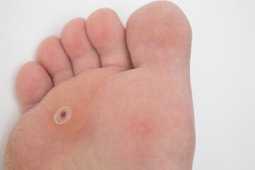 Foot with wart on a toe. Wart verrucas plantar