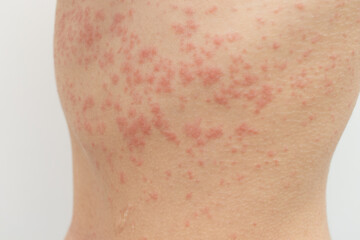 acute Urticaria allergy on woman's back
