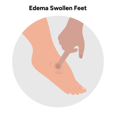 Edema swollen foot 