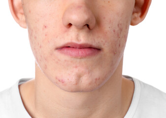 Young man with acne problem isolated on white, closeup