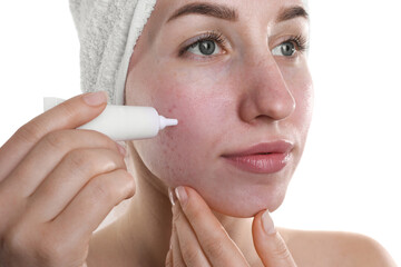 Young woman with acne problem applying cosmetic product onto her skin on white background, closeup