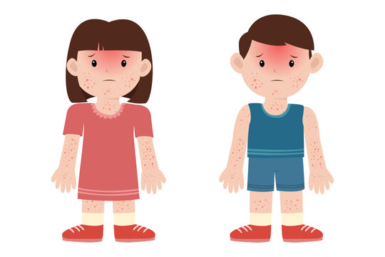 maculopapular rash, dengue fever disease symptom. mosquito control concept