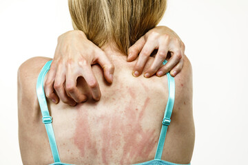 Woman scratching her itchy back with allergy rash - 784514403