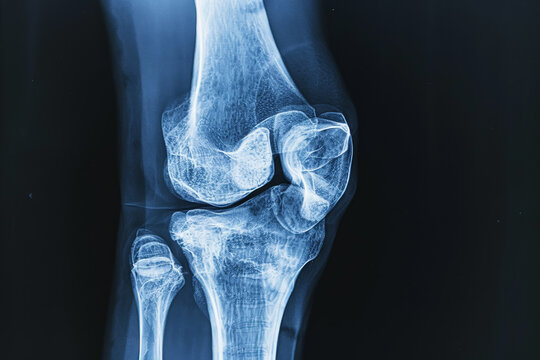 A knee joint is shown in a blue and white color