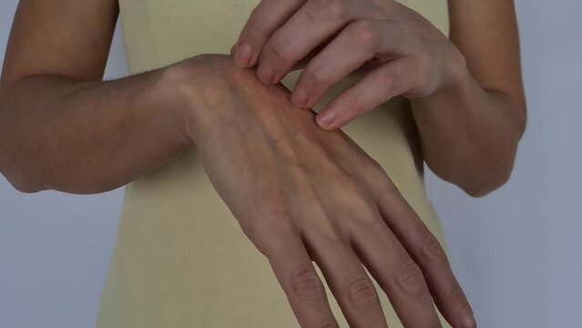 Demonstration of itchy skin and scratching on the hands. Woman scratching her hands closeup