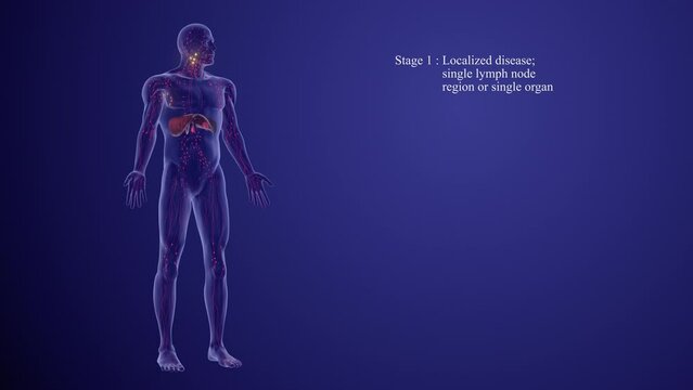 Lymphoma staging and prognosis medical animation
