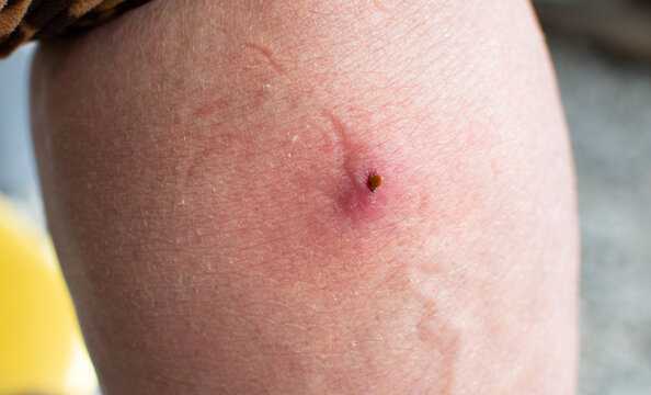 An infected female deer tick on a human leg. A tick bites a person, redness of the skin. Parasitic tick. A dangerous biting insect on the background of a detail of the epidermis.