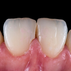 Fototapeta premium emax ceramic veneers
