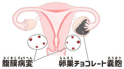 Types of Endometriosis Labeled diagram Superficial peritoneal endometriosis Chocolate cyst