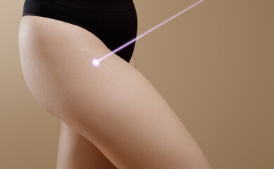 Close-up of female hips with a stretch marks during laser removal session treatment . A woman after weight loss shows stretch marks on the skin. Treatment of skin stretch marks in the clinic - obrazy, fototapety, plakaty