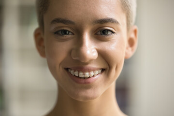 Close up portrait of young 20s blonde European girl with braces, orthodontic treatment for...