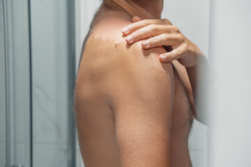 Man peeling of sun damaged peeling skin with a hand on his shoulder and back. Sunburn skin. The...