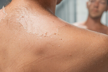 Exfoliation of the skin after sunburn. Man with skin peels off, burnt skin. Close up