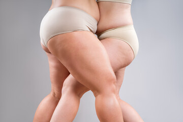 Overweight thighs, two women with fat hips, legs and buttocks, obesity female body with cellulite...