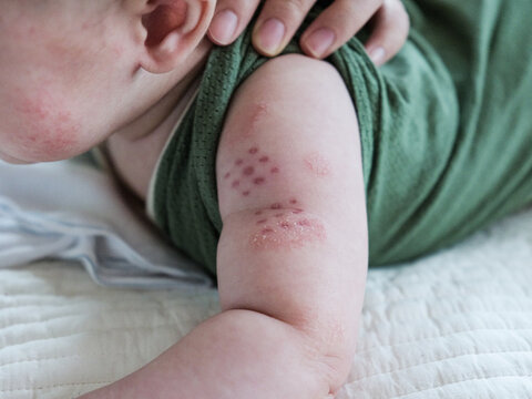 BCG Vaccine Scar on Baby's Arm &ndash; Tuberculosis Immunization Mark