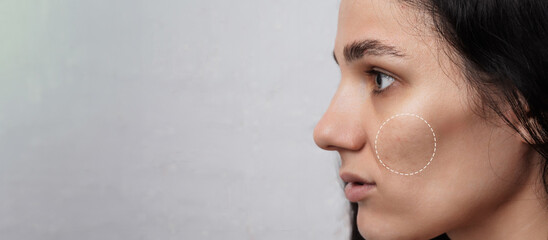 Close-up of a young girl with skin problems. Pimples, acne, pores, scars. Natural skin with and...