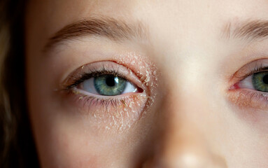 Eye of a little girl suffering from ocular atopic dermatitis or eyelid eczema. - obrazy, fototapety, plakaty