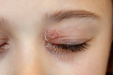 Closed eye of a little girl suffering from ocular atopic dermatitis or eyelid eczema. - 785322611
