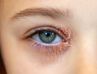 Fototapeta na wymiar Eye of a little girl suffering from ocular atopic dermatitis or eyelid eczema.
