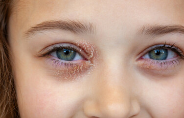 Eye of a little girl suffering from ocular atopic dermatitis or eyelid eczema. Serene and smiling expression. - 785322687