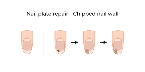 Nail plate repair - Chipped nail wall