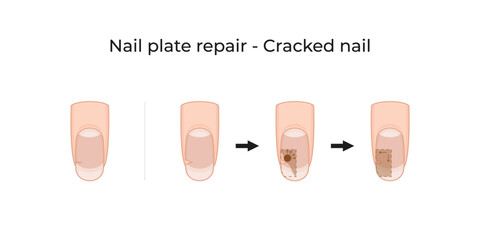 Nail plate repair - Cracked nail