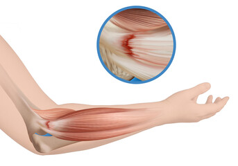 Tennis elbow_Lateral epicondylitis_Medical illustration_Elbow anatomy illustration