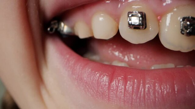 Close up of a smiling teenage girl with braces on her teeth. Girl with braces on her teeth. She is undergoing orthodontic treatment.