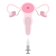 Artificial insemination. In vitro fertilization IVF Artificial insemination and pregnancy ICSI technology. ET Embryo Transfer vector illustration. Reproduction, insemination or ivf - 785744206