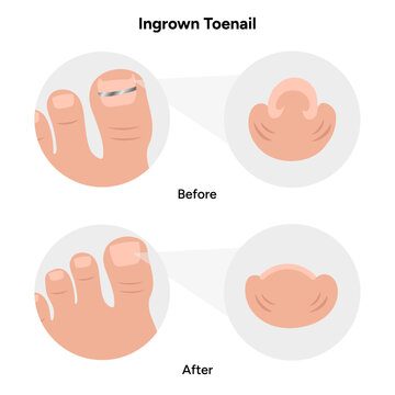 Titanium threads for nails, podiatrist, correct toenail