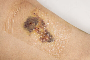 Woman legs after varicose vein surgery, with visible surgical sutures stitches and wounds on a leg.