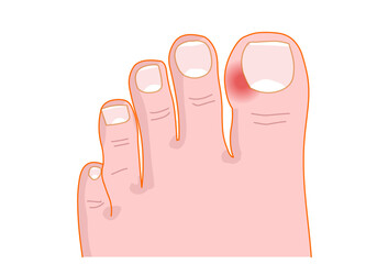 Paronychia is an infection of the proximal and lateral toenail and fingernail fold. Nail fold infections. Vector illustration - obrazy, fototapety, plakaty