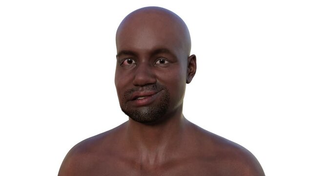 A man with facial palsy, photorealistic 3D animation highlighting the asymmetry and drooping of the facial muscles on one side of the face.