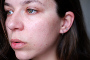 woman's face close-up. problem skin in a woman. rashes, pimples, wrinkles, redness, dark circles on...