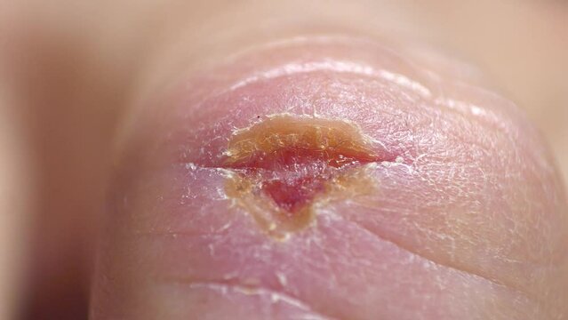 Wound is healing. Self-healing of body. Ten days after injury. There was an injury to middle finger of right hand with bleeding