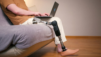 Man amputee with prosthetic leg disability on above knee transfemoral leg prosthesis artificial...