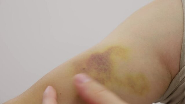Man showing his bruise on forearm. real huge colored hematoma on hand close up 