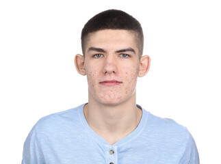 Fototapeta premium Young man with acne problem isolated on white