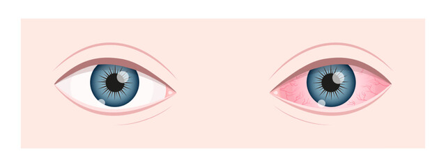 Healthy and ill human vision organ. Dry eye syndrom. Inflamed eyeball with irritation and red conjunctiva. Symptoms of keratitis, blepharitis, conjunctivitis or uveitis. Vector flat illustration.
