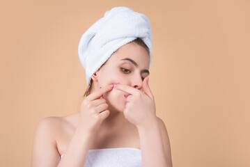Close up Woman squeeze out pimples on cheek. Acne and pimple on skin. Dermatology, puberty woman....
