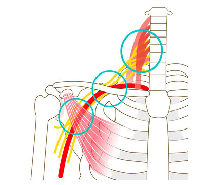 Three gaps that cause thoracic outlet syndrome