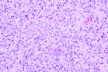 Backgrounds of human cells tissue of lung human under the microscope in pathology lab.View in microscopic of ductal cell carcinoma, adenonocarcinoma from human breast cancer, tissue section by H and E